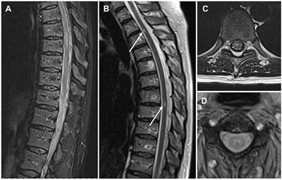 Delimiting MOGAD as a disease entity using translational imaging